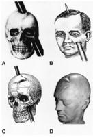 !! Accidents: Phineas Gage.