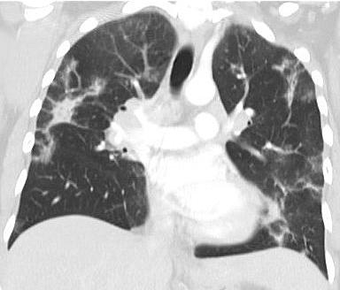 DIFFUSE LUNG