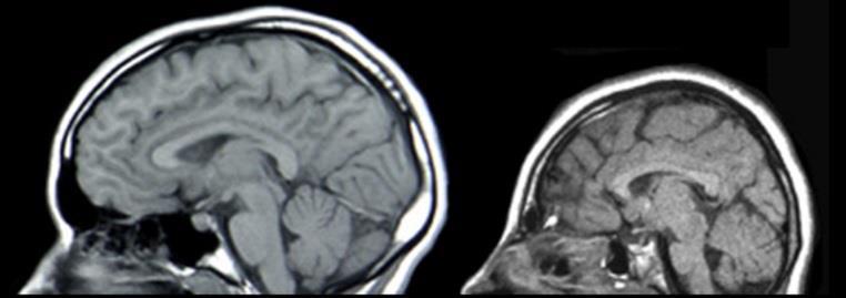 Zika and the Fetal Brain Resulting in a reduction in the number of brain