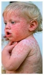 Rubella One of the Famous Five pediatric infections associated with a rash Relatively benign in