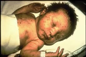 Congenital Rubella Between 1963 and 1965 a rubella epidemic swept the USA 20,000 pregnant women who contracted