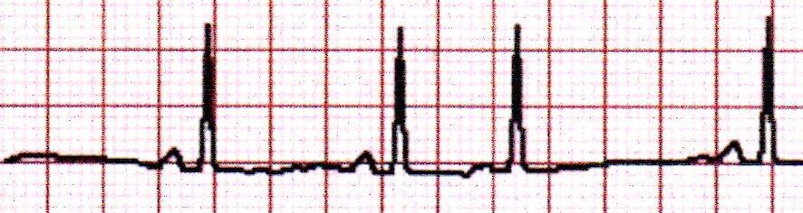 Compensatory Pause Normal RR Interval PAC Premature Atrial Contraction