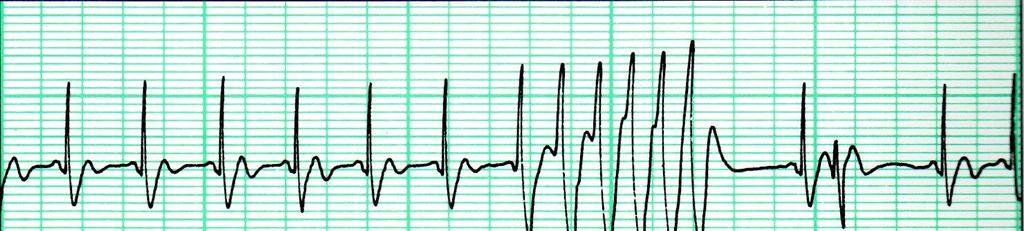 Ventricular Tachycardia, Irregular & No P waves