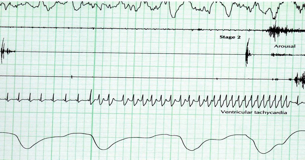 NSR Slow Fast Ventricular tachycardia Atlas