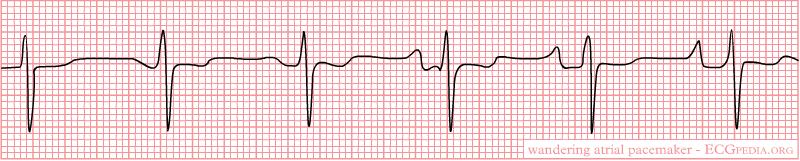 P Waves Wandering Pacemaker (Changing