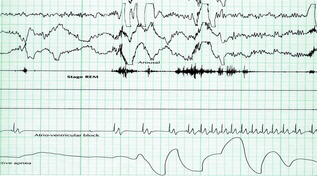 Junctional Escape Beats, No P wave, Narrow QRS Sinus Rhythm NSR Apnea in REM, AV Block Vent