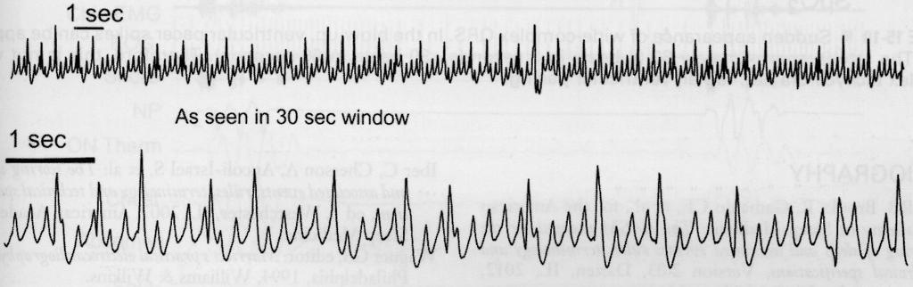 F Flutter Waves Atrial Flutter (F waves) with Variable