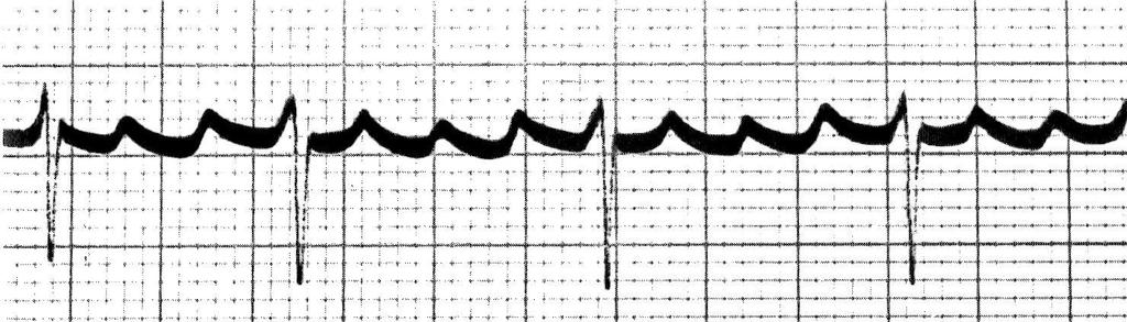Two Flutter Waves Three Flutter Waves QRS Complex Atrial