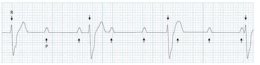 PP Interval Wide QRS Complex R Wave P RR Interval 3 rd Degree Complete Heart Block, No