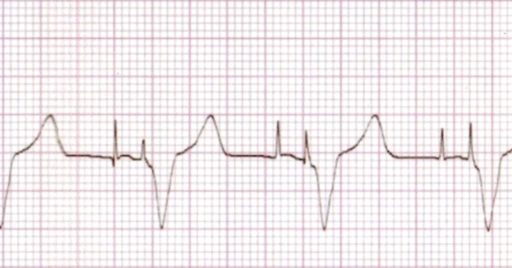 Atrial Spike Ventricular Spike P wave T Wave