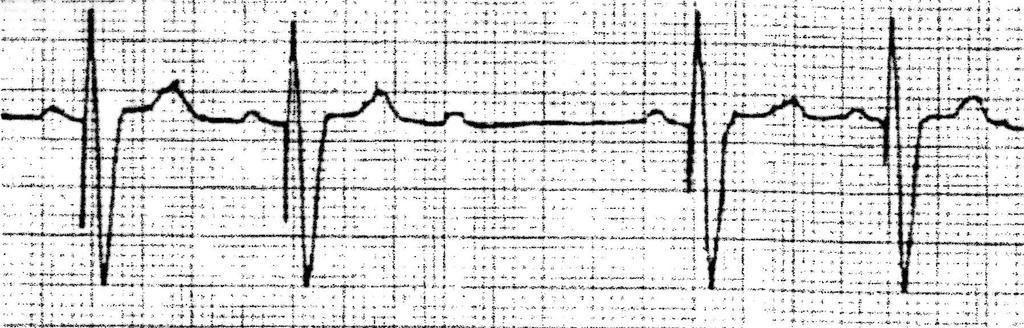 P Wave Absence Of Ventricular Spike & QRS Complex Ventricular
