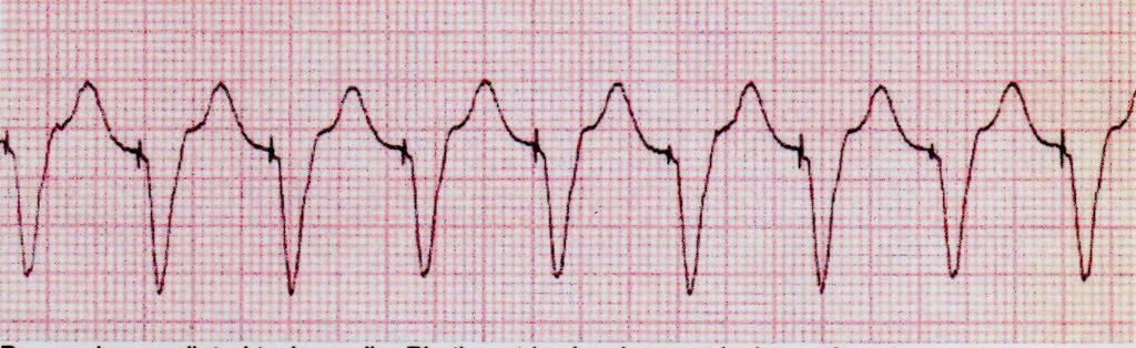 Ventricular Pacemaker Spikes Paced Rhythm By A Single Ventricular
