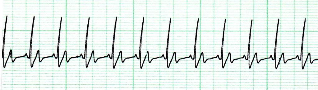 Cardiac Arrhythmias in Sleep Steps In Interpretation of Cardiac Rhythm: First: Change to 10 seconds window Second: Identify P Waves Third: Observe Relation Of P wave with QRS Complex Fourth : Measure