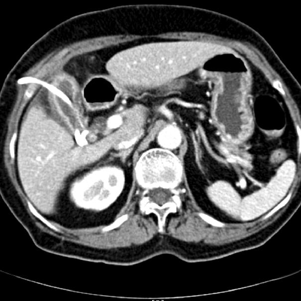 (B, D) Follow up CT image obtained days after percutaneous transhepatic gallbladder drainage shows marked resolution of the abscess with drainage tube.