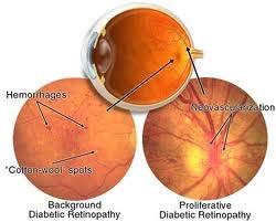Screen all athletes Retinopathy Diabetic athletes need yearly exam If present: avoid