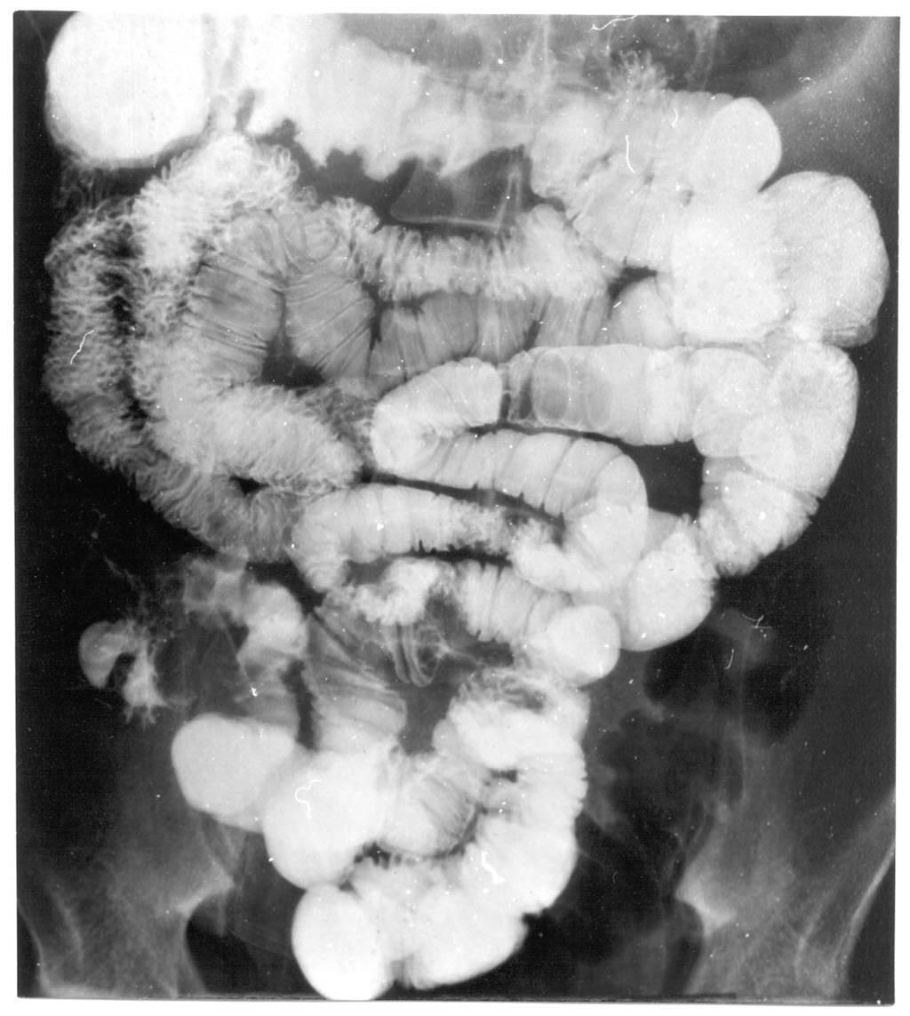 SMALL BOWEL OBSTRUCTION Failure to improve warrants CT scan if not already done Gastrograffin SBFT- Hypertonic contrast draws fluid