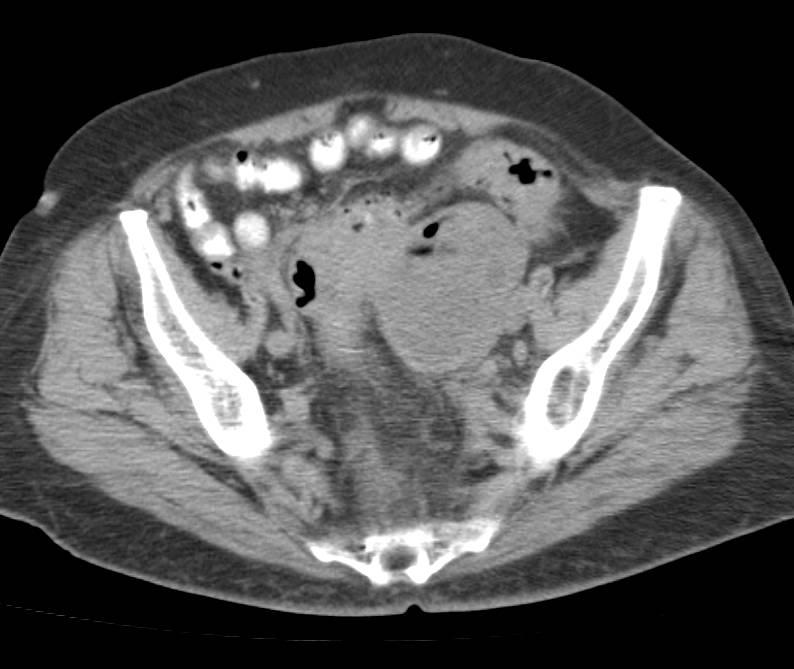 COMPLICATED DIVERTICULITIS Peritonitis Obstruction Free perforation-