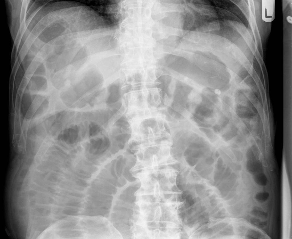 SMALL BOWEL OBSTRUCTION Common problem, usually managed non-operatively