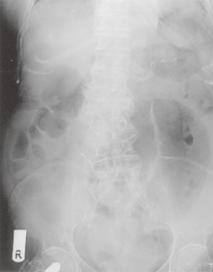 M e d i c a l E d u c a t i o n Singapore Med J 2005; 46(9) : 483 CME Article Clinics in diagnostic imaging (105) C T Wai, G Lau, C J L Khor Fig. 1 Abdominal radiograph obtained on admission.