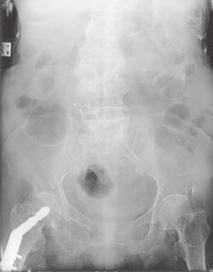 During bowel preparation with polyethylene glycol (Fortranf, Sime Darby Marketing, Singapore), she started vomiting, and complained of abdominal pain. Physical examination showed a distended Fig.
