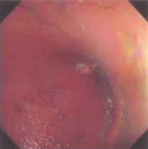 Singapore Med J 2005; 46(9) : 484 Fig. 3 Endoscopic photograph of the distal sigmoid colon shows normal mucosa and an empty lumen Fig.