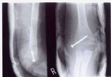 Check radiographs are requested at one week follow up and confirmed no loss of reduction. The metalwork was removed at three months postoperatively.