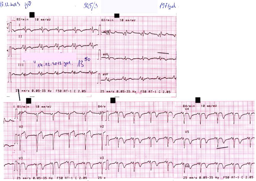 segment of the lateral wall. 24-h electrocardiographic (ECG) Holter recording did not register complex disorders of heart rate and implementation.