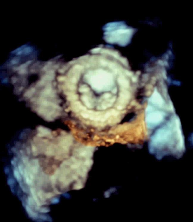 42 year-old patient operated 5x for mitral valve replacement Severe mitral prosthesis stenosis Acute heart failure with shock and