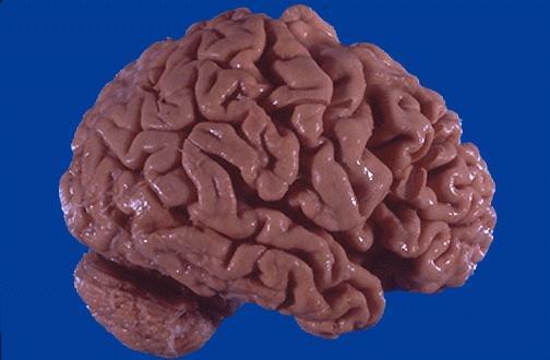 Brain Atrophy in Alzheimer s Disease Definite diagnosis of Alzheimer s usually requires post-mortem brain examination.