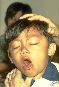 Stages of Pertussis disease Catarrhal stage 1 to 2 weeks: runny nose, sneezing, mild temperature Paroxysmal cough stage 1 to 6