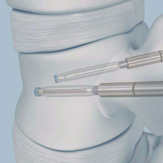 INFLATE THE SYNFLATE VERTEBRAL BALLOON BALLOON INSERTION Insert the balloon catheter under lateral radiographic control.