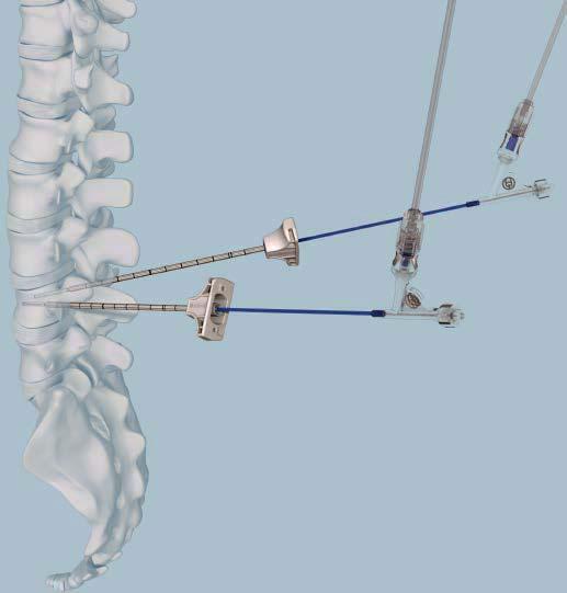 For insertion, the catheter stiffening wire must be mounted to the catheter. Check the balloon position by identifying the markers of the balloon under fluoroscopy in AP and lateral view.