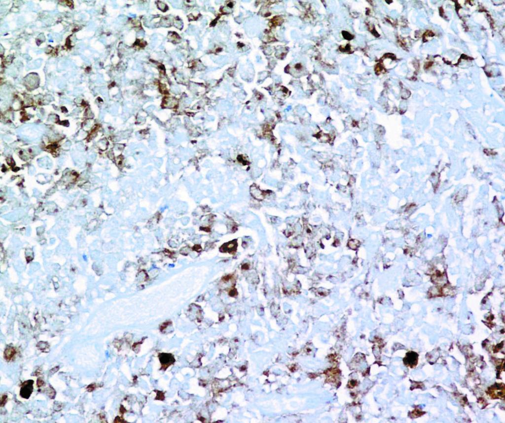 staining in the necrotic area of the tumor ( 20).