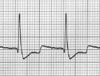 What are the 8 steps needed to analyze an? Analysis in 8 Steps What measurement can be used to determine whether the ventricular rhythm is regular or irregular?