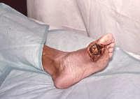 superficial necrosis of the foot or