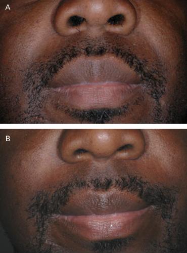 SIX-MONTH SAFETY RESULTS OF CALCIUM HYDROXYLAPATITE Figure 2. (A) This 43-year-old man received a total of 1.2 ml of calcium hydroxylapatite (0.6 ml in his left nasolabial fold, 0.
