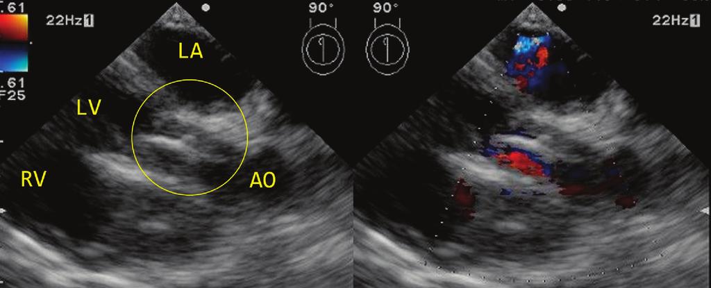 The defect was almost completely occluded without aortic blood flow blockage, and hemodynamic exacerbation was not observed during insertion, despite protrusion of the device a few millimeters into