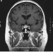 Gadolinium-enhanced, T1-weighted coronal MRI scans showing a microadenoma and a