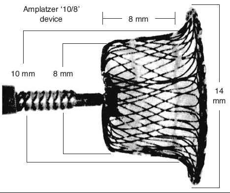 The Duct Occluder Device n The occluder is a cone-shaped device 7 mm in length made of a 0.004-inch Nitinol wire mesh.