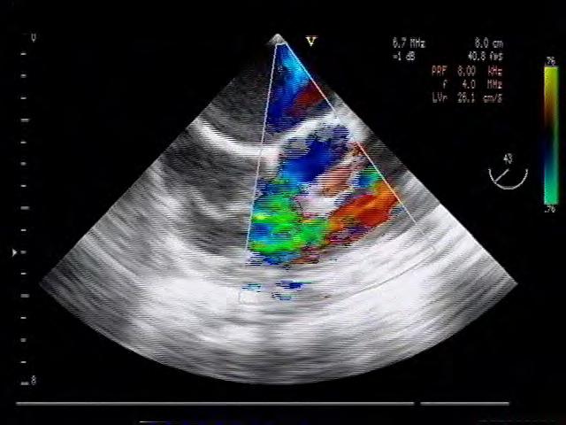 Perimembranous VSD Echocardiographic