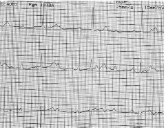 Complete -AVB Large variability in Clinical presentation (asymptomatic-mild