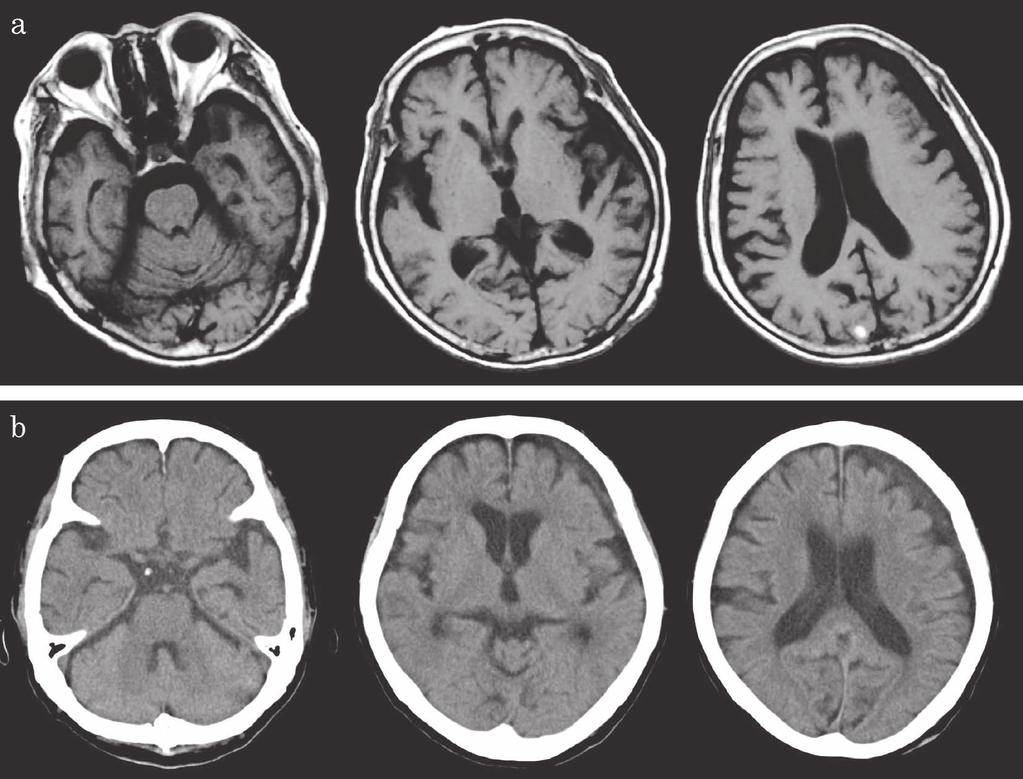 344 Dementia Japan Vol. 26 No. 3 September 2012 15 Mini - Mental State Examination 17 serial 7 MRI SDH 1 cm Fig 1a 10 CT SDH Fig. 1b X 1 4 5 : : 6.2 g/dl CT Fig. 1b Fig. 2a Evans index 0.26 2 0.28 0.