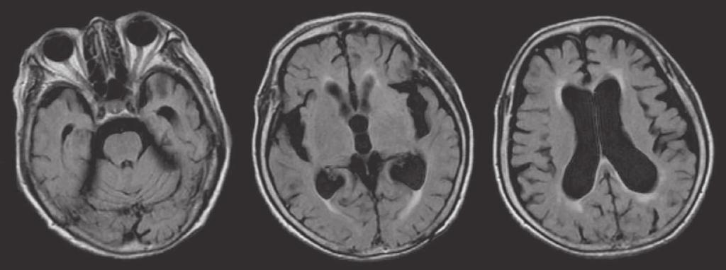 (b)after more 3 weeks, periventricular leukomalacia has increased. Fig. 3. Head MRI a half of year after tap test.