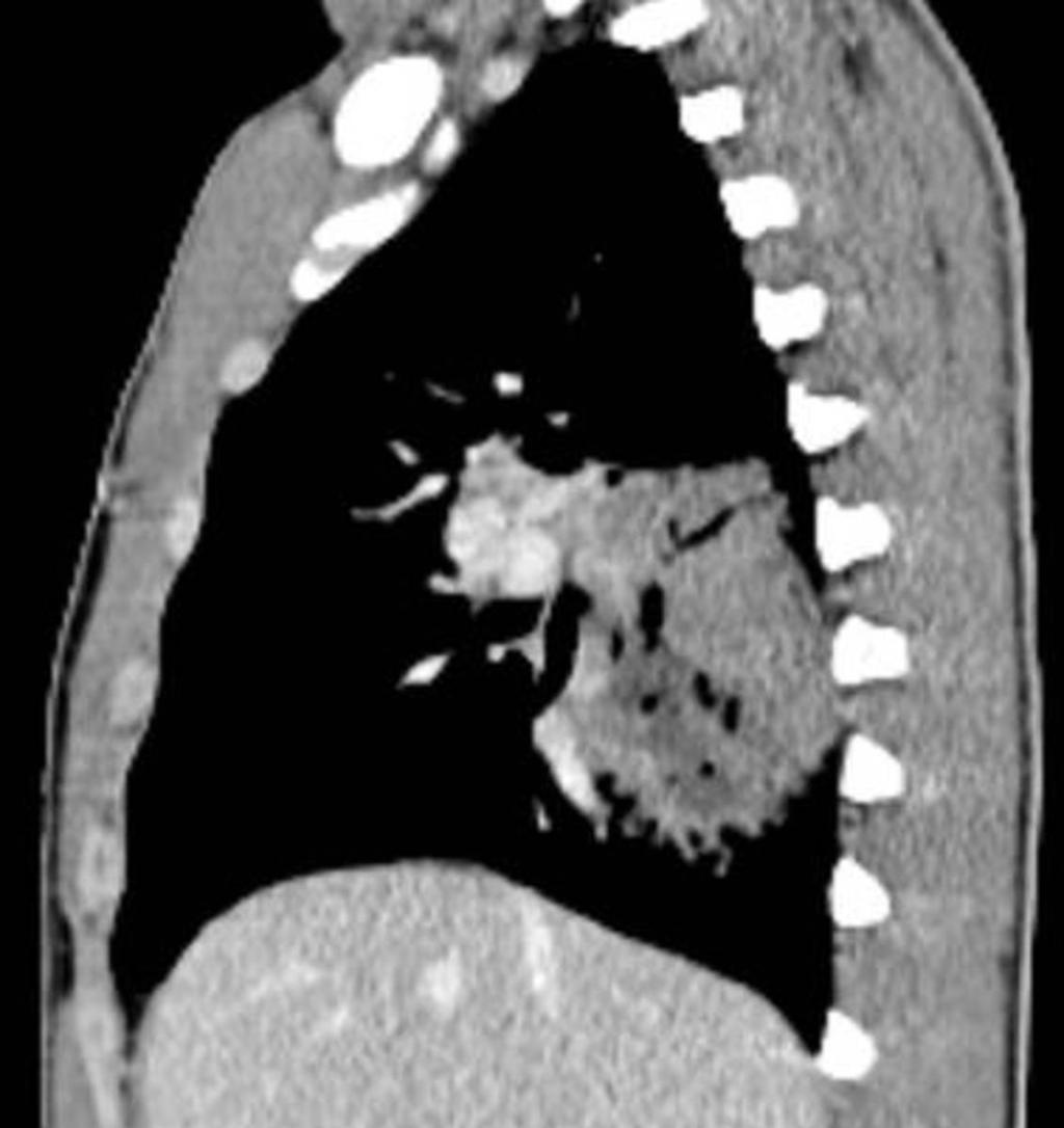 Fig. 6: Sagital reformation: lung mass with hypodenses
