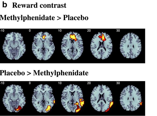 MPH Normalizes Under activation in ADHD - 2 Error Detection task On MPH Frontocingulate activates