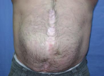 Patient history The patient is a 48 year-old healthy male with recurrent large ventral hernia. He developed a ventral hernia statuspost emergent splenectomy 3 years prior.