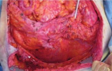 XCM Biologic Tissue Matrix. Components separation using sandwich technique for reconstruction of abdominal wall defect.