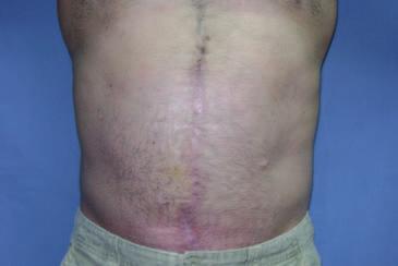 Postoperative treatment Following these procedures, the patient wears an abdominal binder for 4 6 weeks postoperatively.