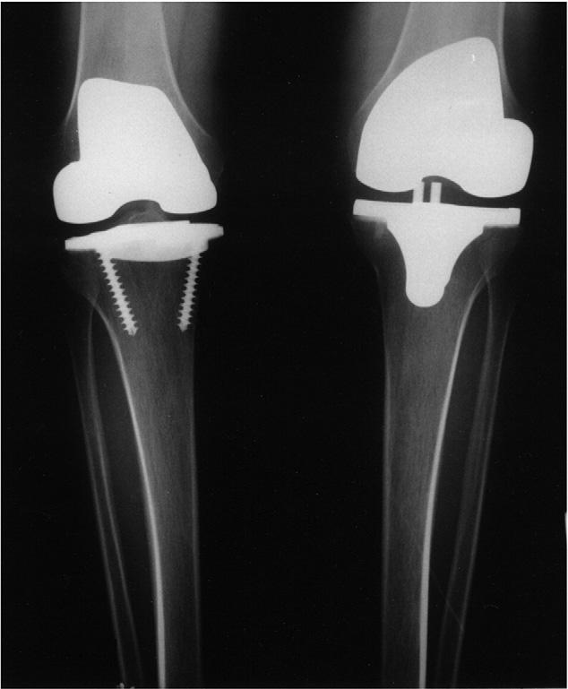 Bicruciate-Retaining or Medial Pivot Total Knee Prosthesis Pritchett 225 Fig. 3. The MP total knee prosthesis. Fig. 1.