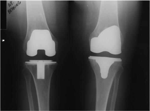 arthroplasties were offered enrollment in this randomized, prospective study. Randomization of the prosthesis was determined from a sequential pool on the basis of a table of random numbers.